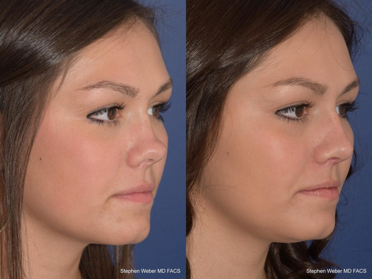 Revision Rhinoplasty Before & After Gallery - Patient 168765 - Image 5