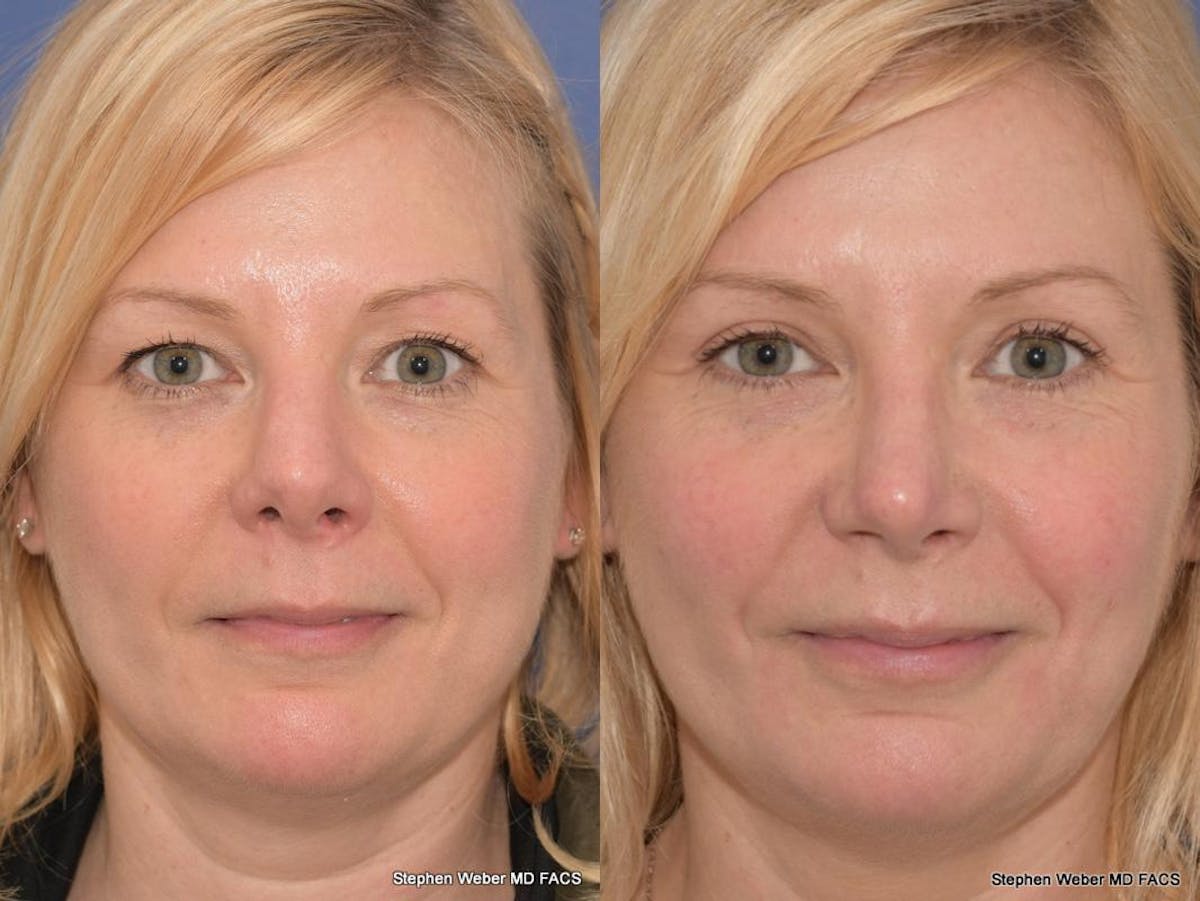 Rhinoplasty Before & After Gallery - Patient 648059 - Image 1