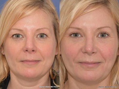Revision Rhinoplasty Before & After Gallery - Patient 275753 - Image 1