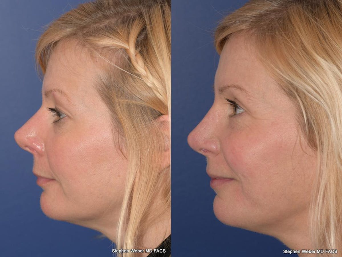 Rhinoplasty Before & After Gallery - Patient 648059 - Image 2