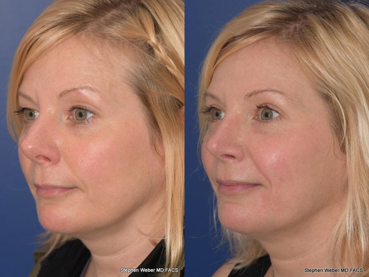 Rhinoplasty Before & After Gallery - Patient 648059 - Image 3