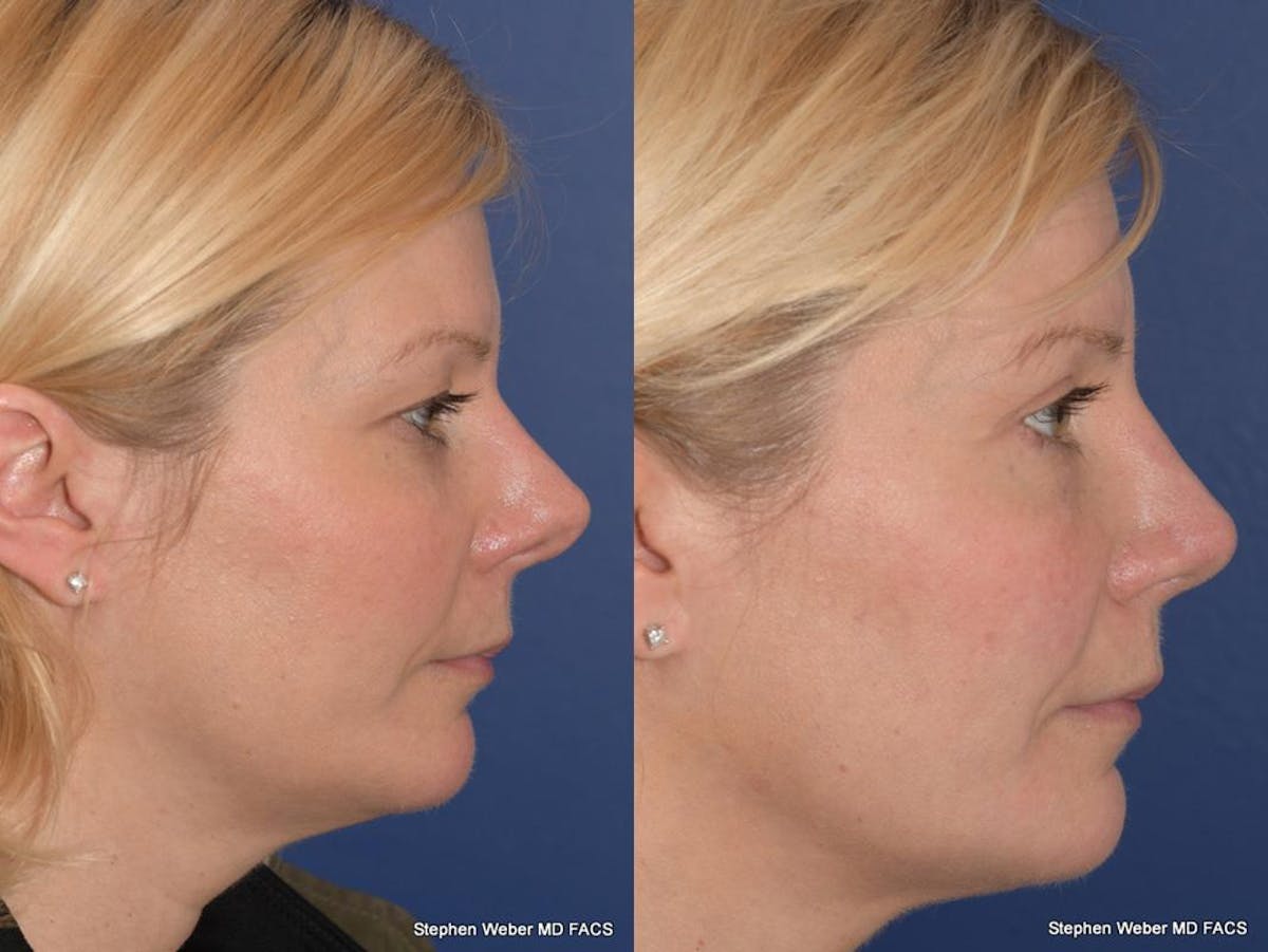 Rhinoplasty Before & After Gallery - Patient 648059 - Image 4