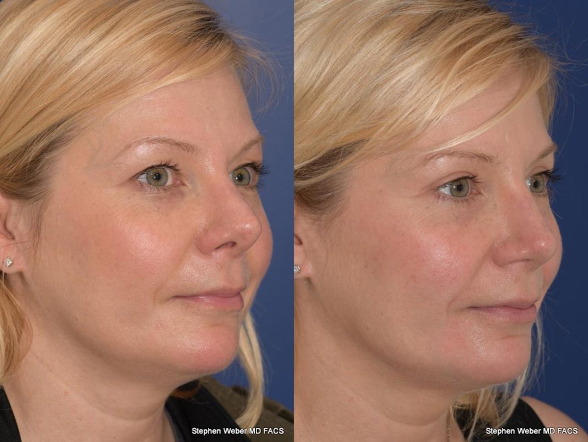 Rhinoplasty Before & After Gallery - Patient 648059 - Image 5