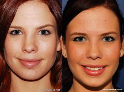 Revision Rhinoplasty Before & After Gallery - Patient 359627 - Image 1