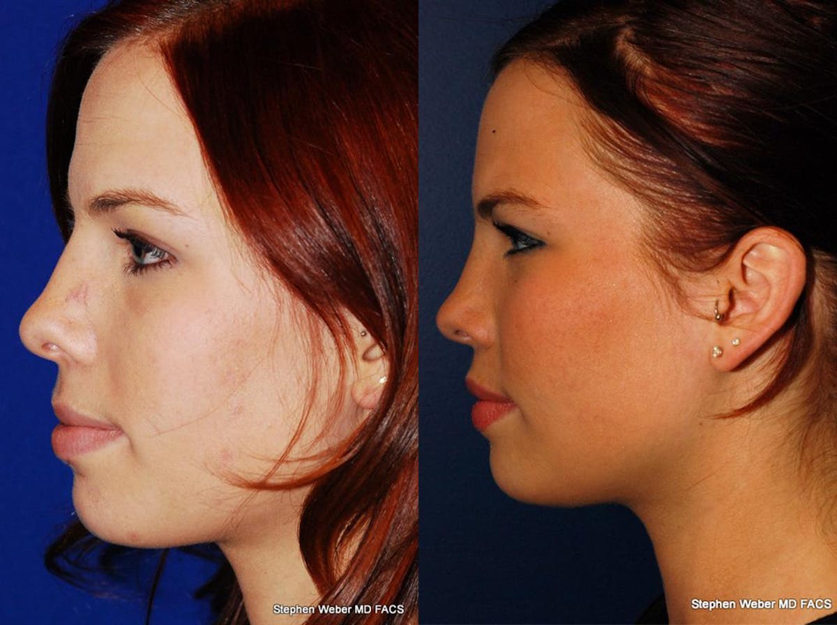 Rhinoplasty Before & After Gallery - Patient 189592 - Image 2