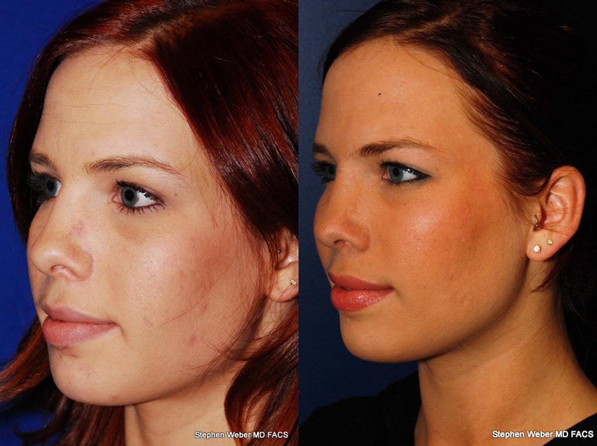 Rhinoplasty Before & After Gallery - Patient 189592 - Image 3