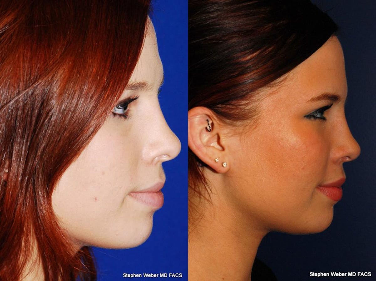 Rhinoplasty Before & After Gallery - Patient 189592 - Image 4