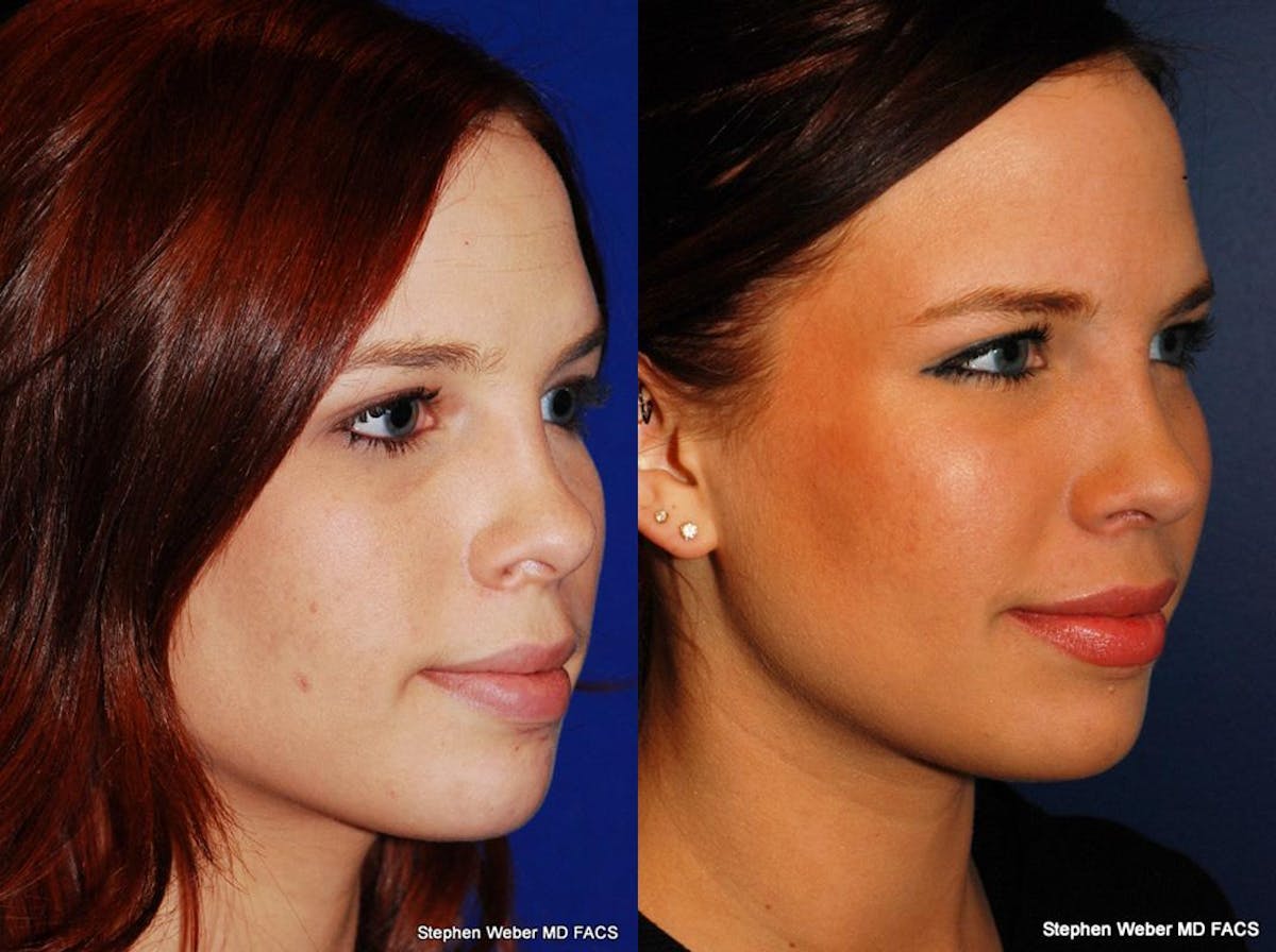 Rhinoplasty Before & After Gallery - Patient 189592 - Image 5