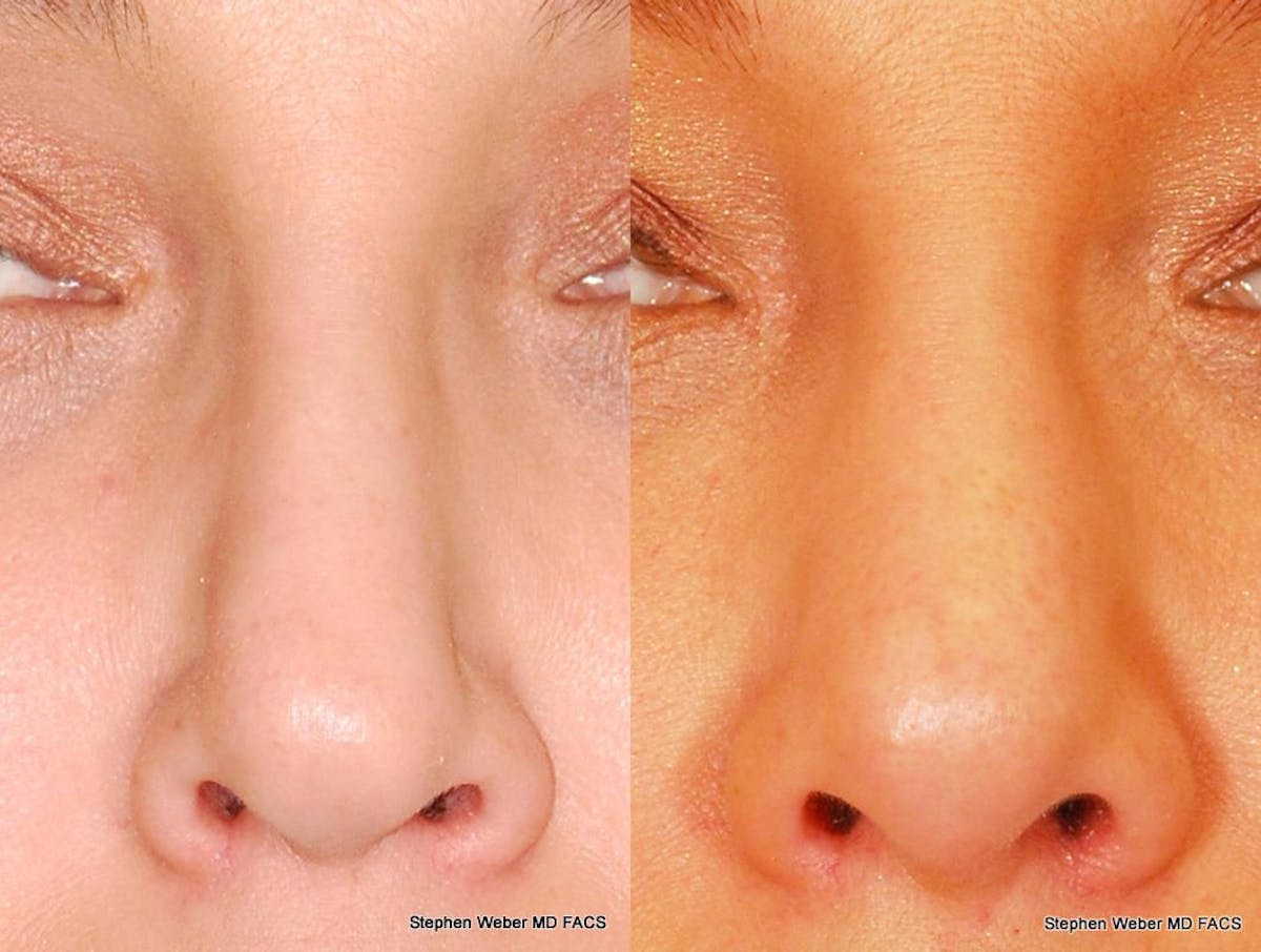 Revision Rhinoplasty Before & After Gallery - Patient 323363 - Image 1