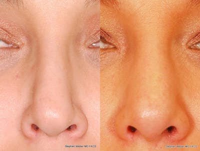 Revision Rhinoplasty Before & After Gallery - Patient 323363 - Image 1