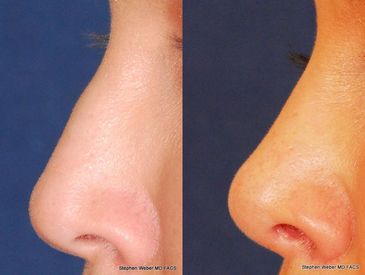 Revision Rhinoplasty Before & After Gallery - Patient 323363 - Image 2