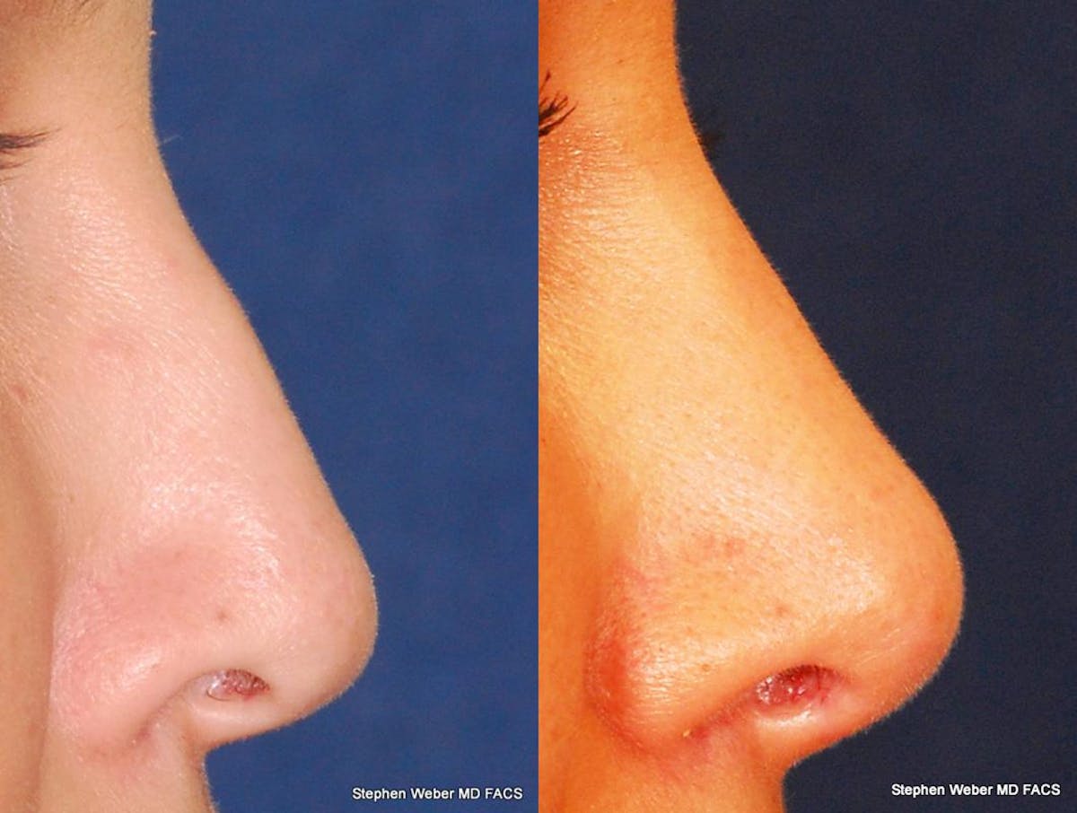 Revision Rhinoplasty Before & After Gallery - Patient 323363 - Image 3