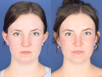 Rhinoplasty Before & After Gallery - Patient 313771 - Image 1