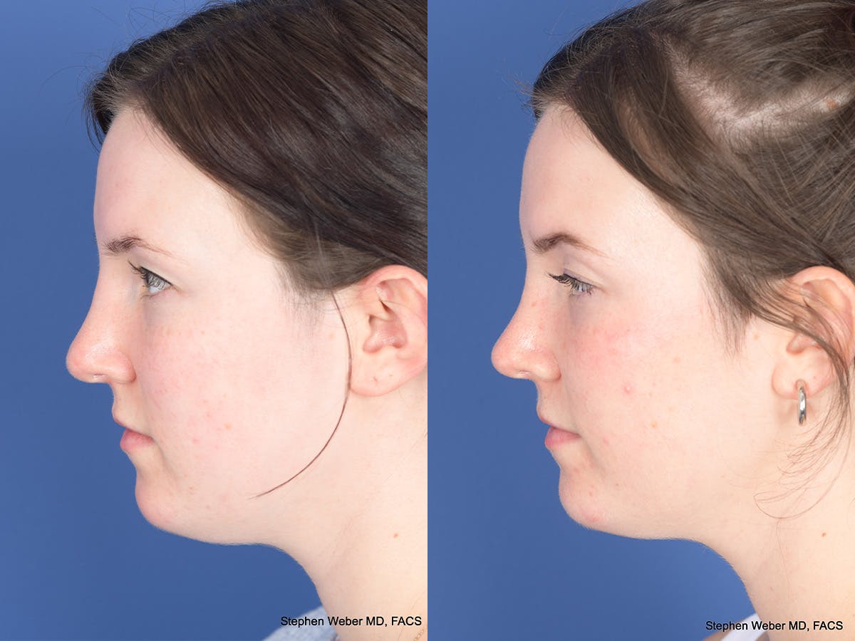 Rhinoplasty Before & After Gallery - Patient 313771 - Image 2
