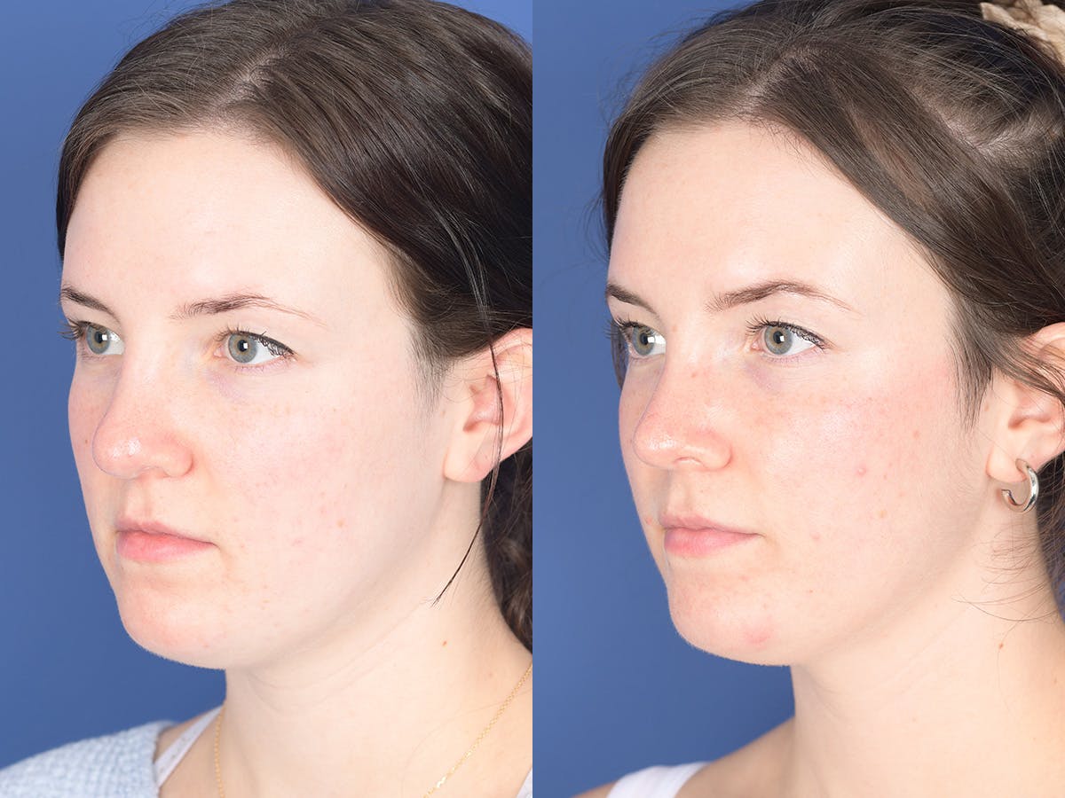 Rhinoplasty Before & After Gallery - Patient 313771 - Image 3