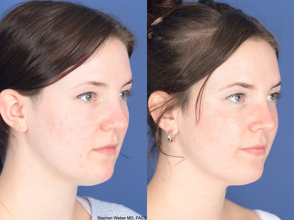 Rhinoplasty Before & After Gallery - Patient 313771 - Image 4