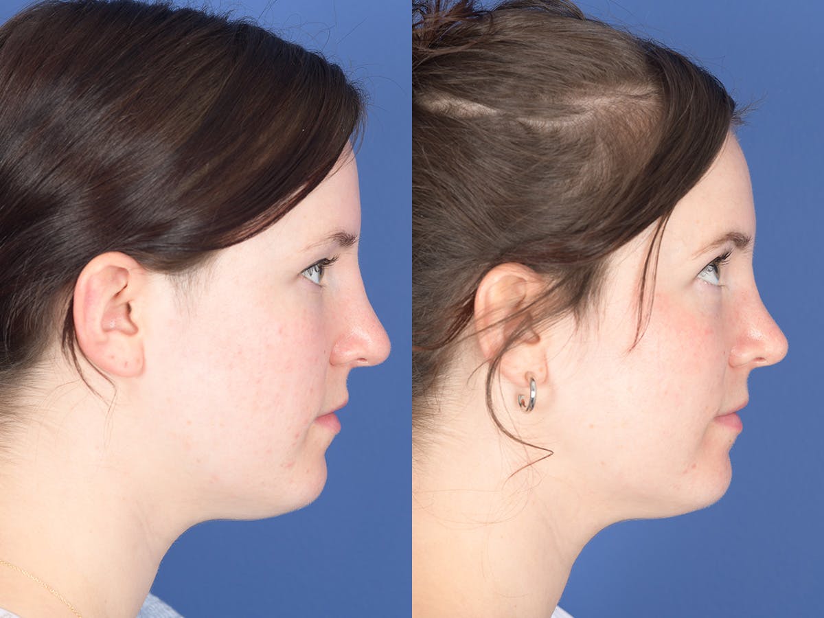 Rhinoplasty Before & After Gallery - Patient 313771 - Image 5