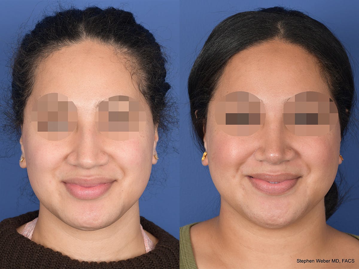 Rhinoplasty Before & After Gallery - Patient 129015 - Image 1