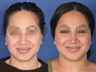 Rhinoplasty Before & After Gallery - Patient 129015 - Image 1