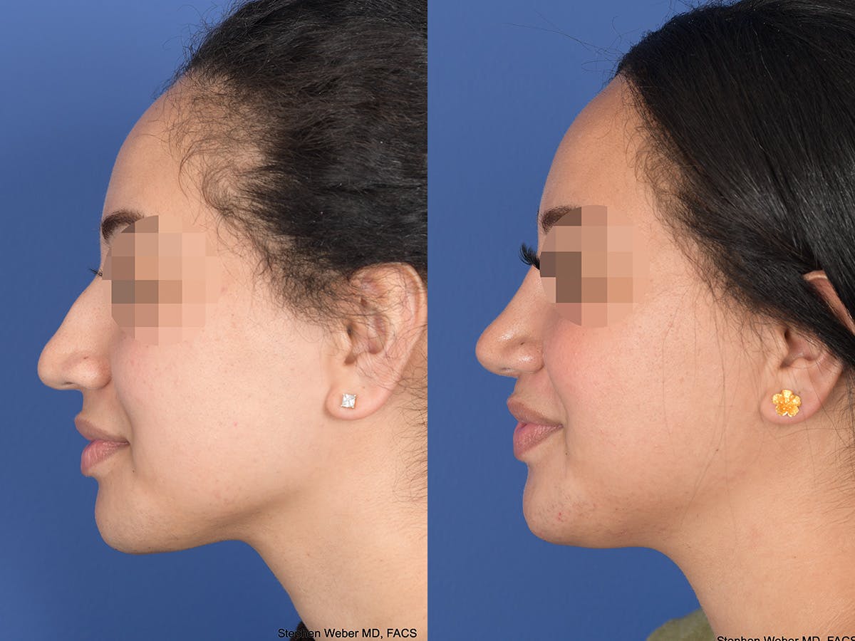 Rhinoplasty Before & After Gallery - Patient 129015 - Image 2