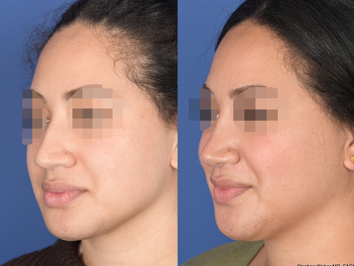 Rhinoplasty Before & After Gallery - Patient 129015 - Image 3