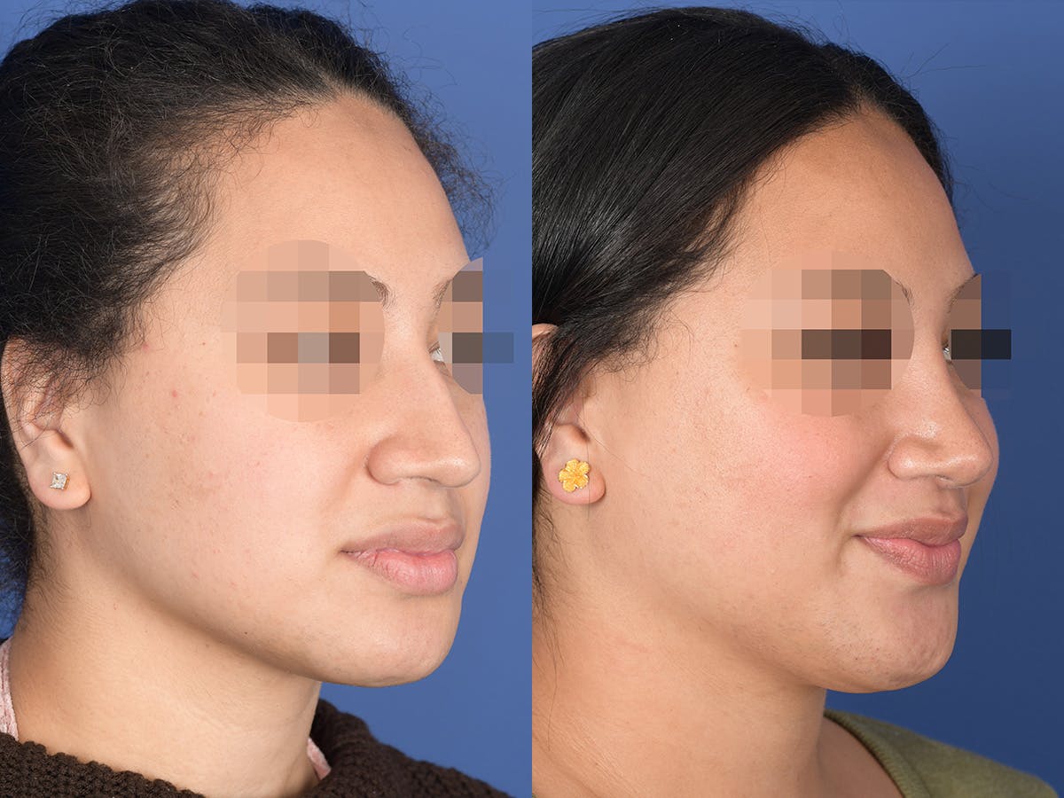 Rhinoplasty Before & After Gallery - Patient 129015 - Image 4