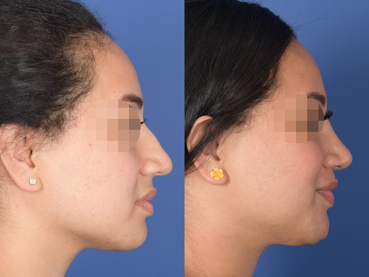 Rhinoplasty Before & After Gallery - Patient 129015 - Image 5