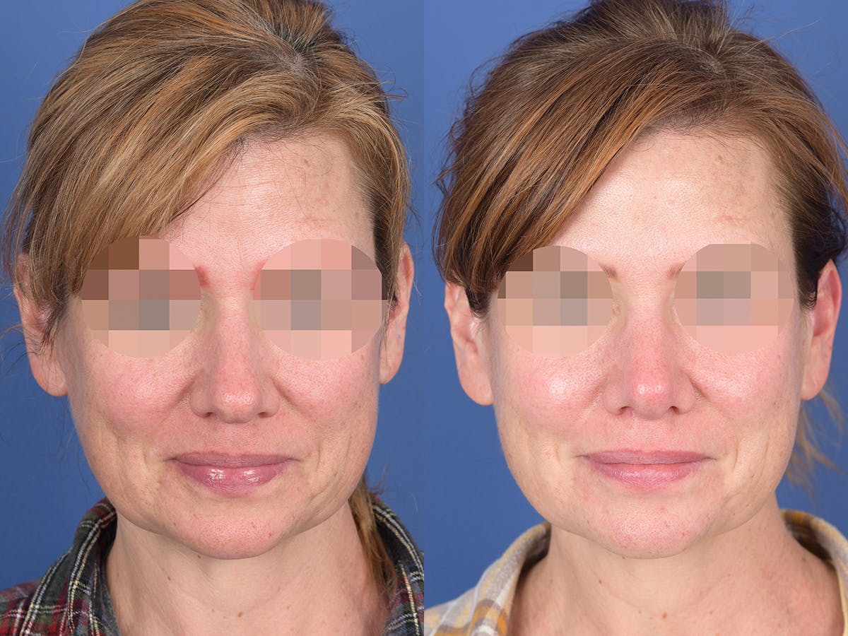 Rhinoplasty Before & After Gallery - Patient 214153 - Image 1