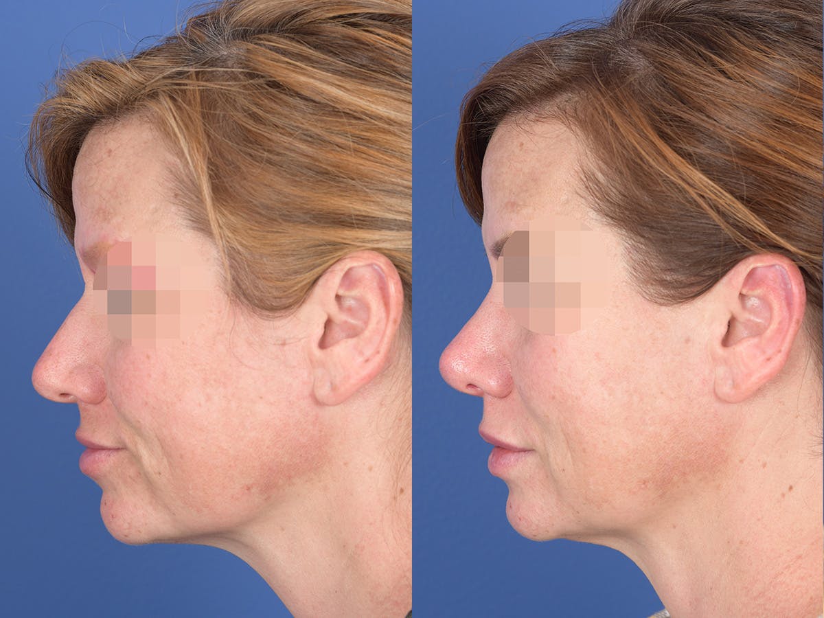 Rhinoplasty Before & After Gallery - Patient 214153 - Image 2