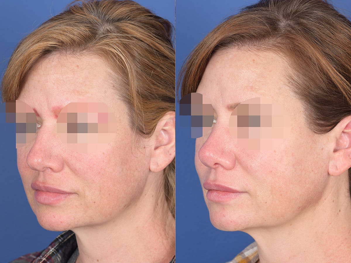 Rhinoplasty Before & After Gallery - Patient 214153 - Image 3