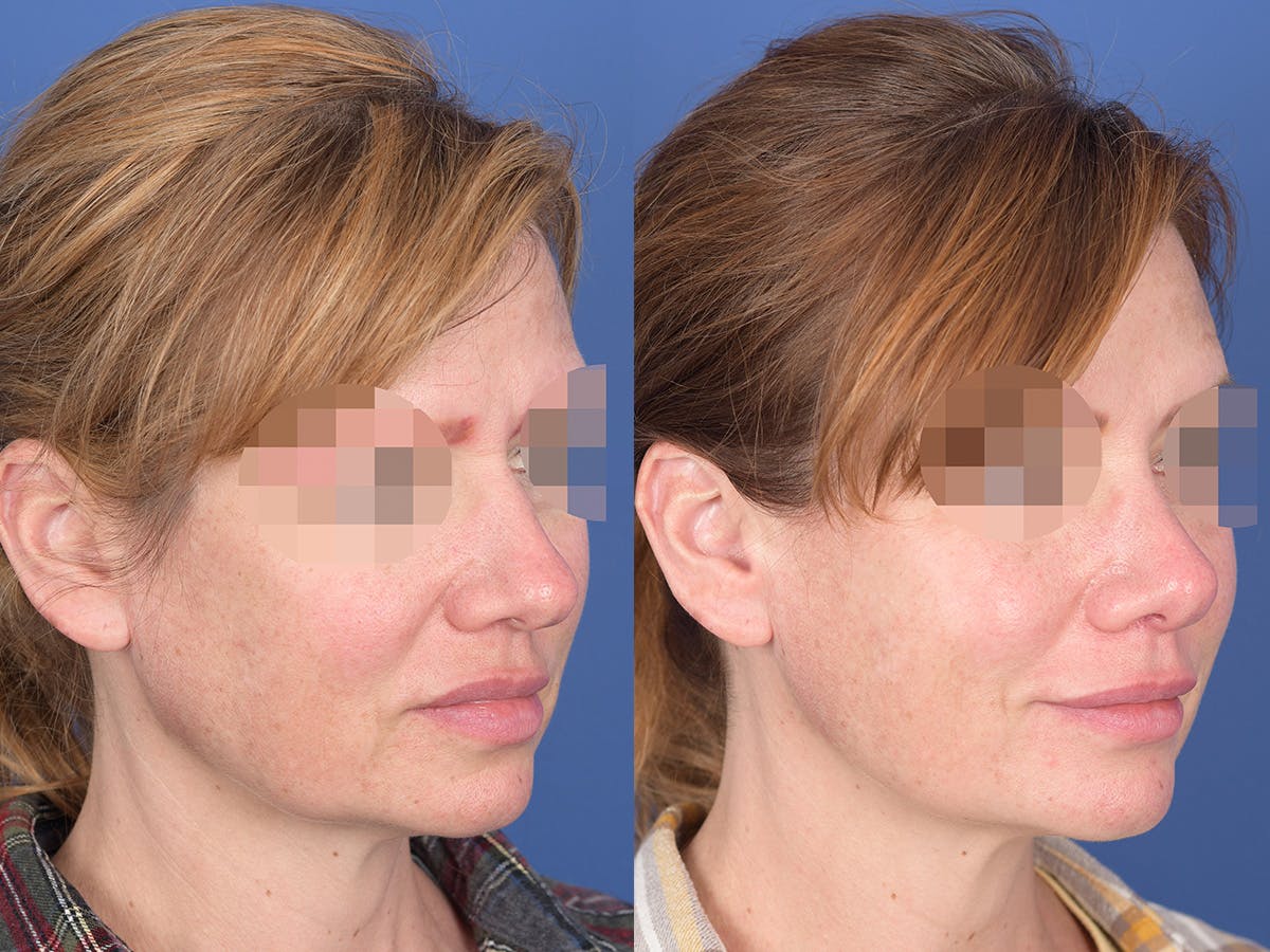 Rhinoplasty Before & After Gallery - Patient 214153 - Image 4