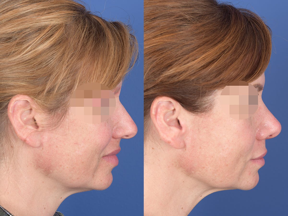 Rhinoplasty Before & After Gallery - Patient 214153 - Image 5