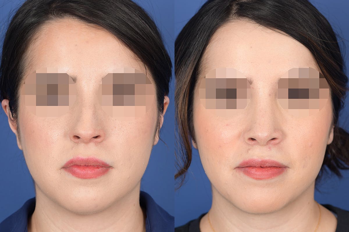 Rhinoplasty Before & After Gallery - Patient 782711 - Image 1