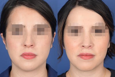Rhinoplasty Before & After Gallery - Patient 782711 - Image 1