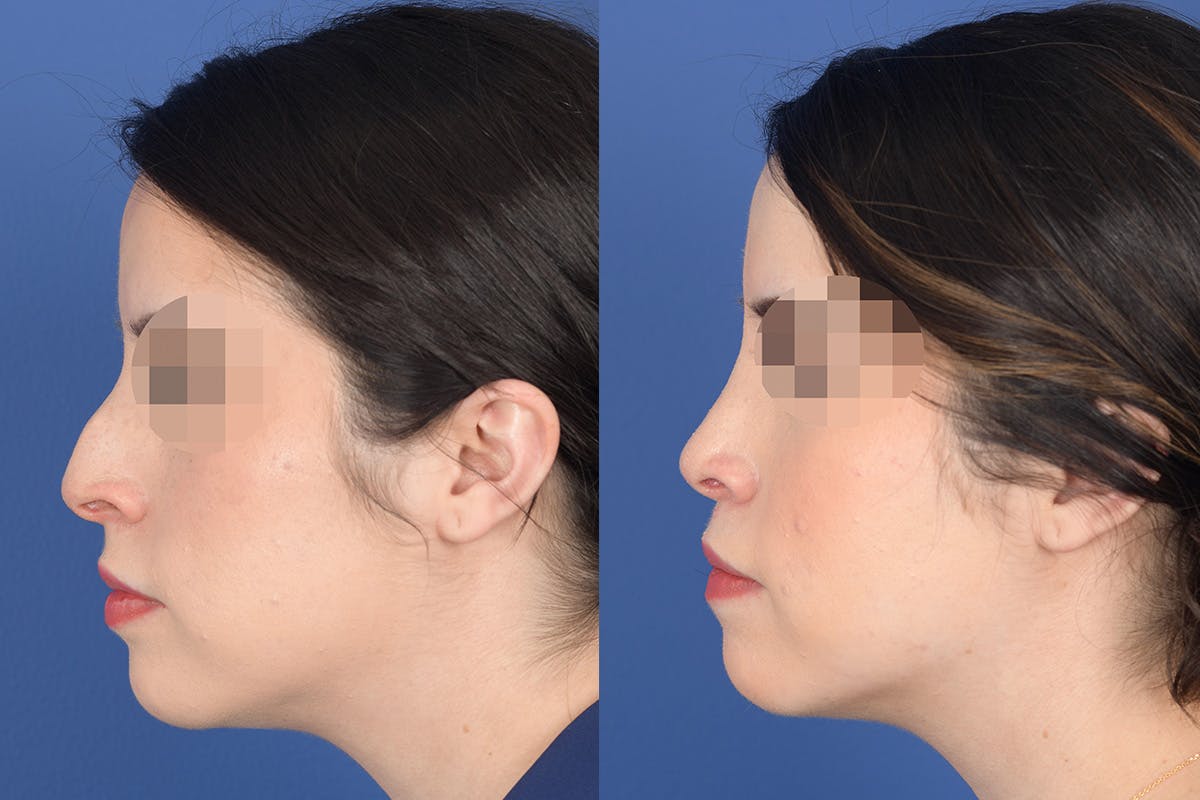 Rhinoplasty Before & After Gallery - Patient 782711 - Image 2