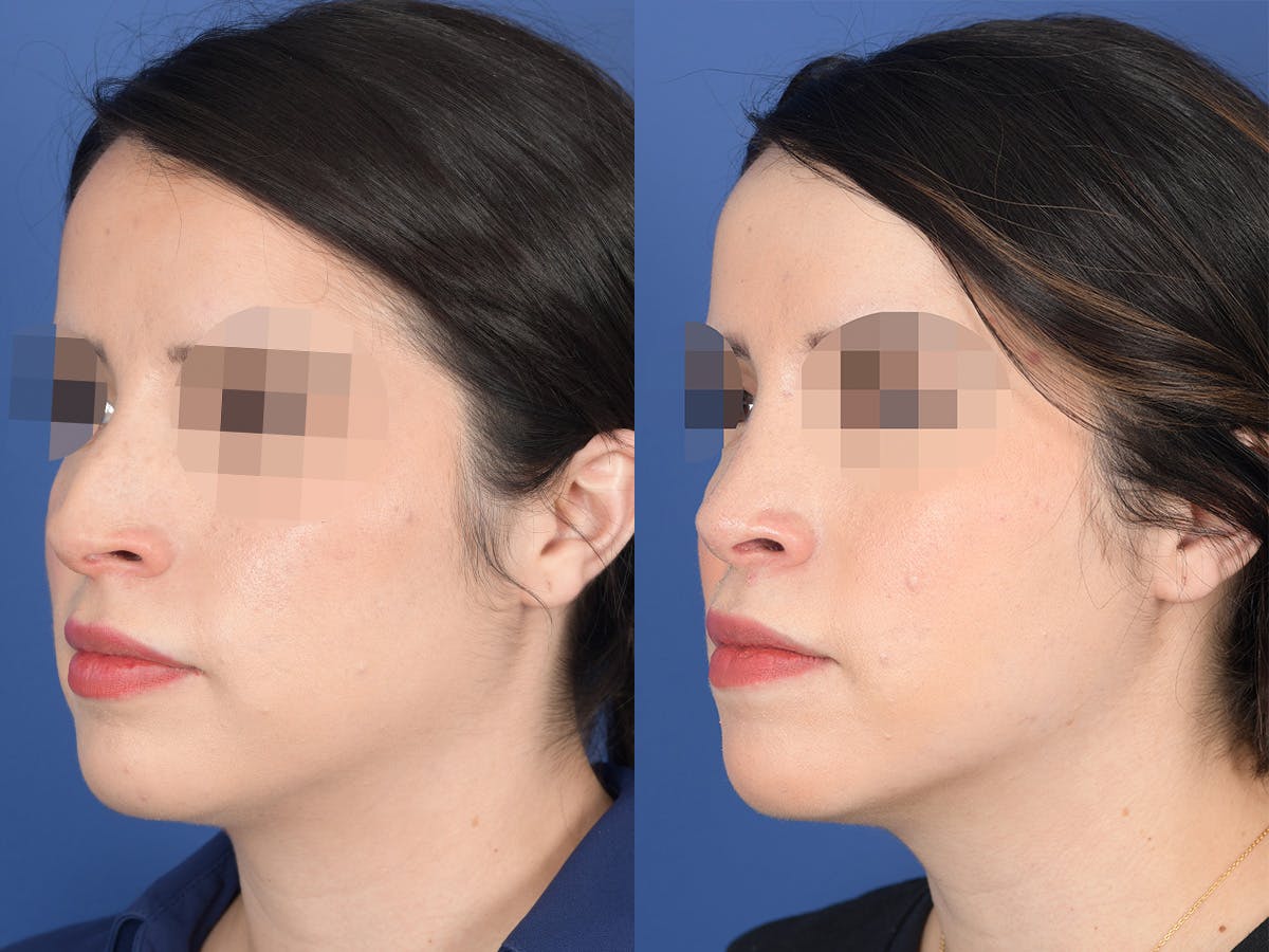 Rhinoplasty Before & After Gallery - Patient 782711 - Image 3