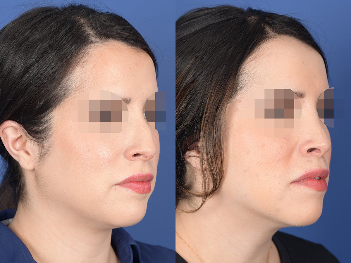 Rhinoplasty Before & After Gallery - Patient 782711 - Image 4