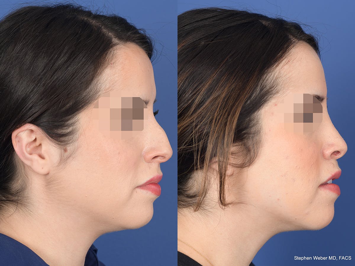 Rhinoplasty Before & After Gallery - Patient 782711 - Image 5