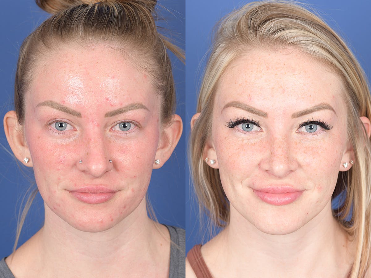 Rhinoplasty Before & After Gallery - Patient 266079 - Image 1