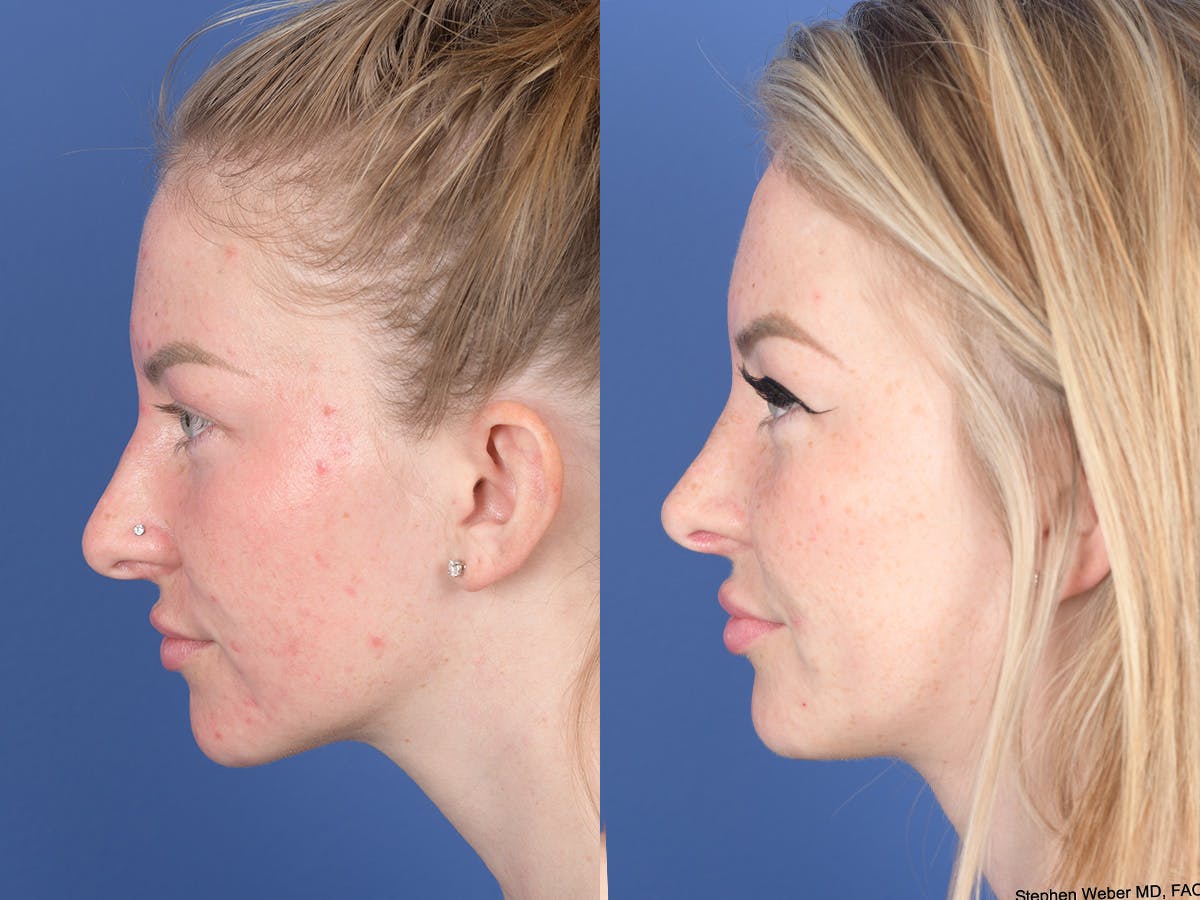 Rhinoplasty Before & After Gallery - Patient 266079 - Image 2