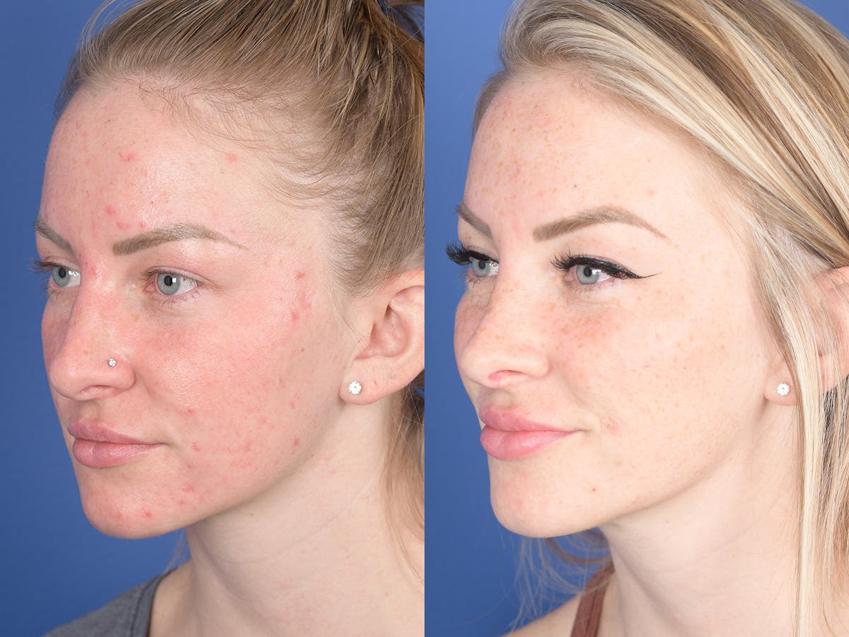 Rhinoplasty Before & After Gallery - Patient 266079 - Image 3
