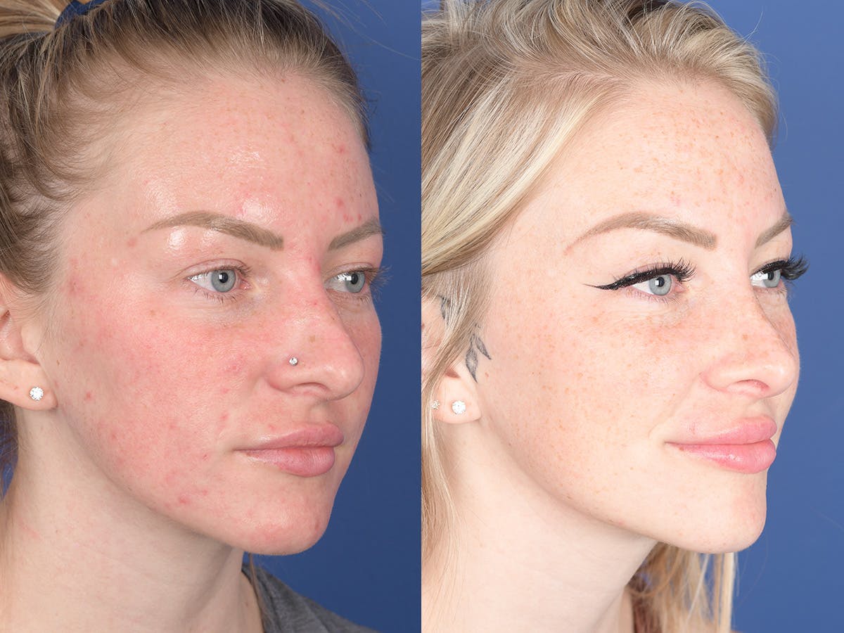 Rhinoplasty Before & After Gallery - Patient 266079 - Image 4