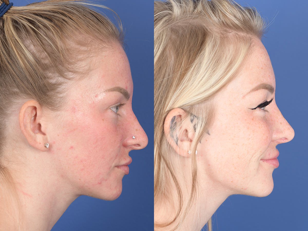 Rhinoplasty Before & After Gallery - Patient 266079 - Image 5