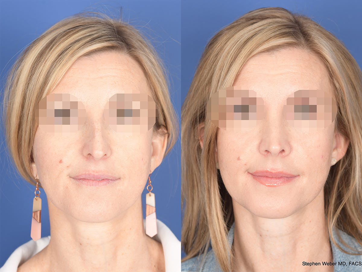 Rhinoplasty Before & After Gallery - Patient 378354 - Image 1
