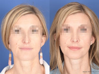 Rhinoplasty Before & After Gallery - Patient 378354 - Image 1
