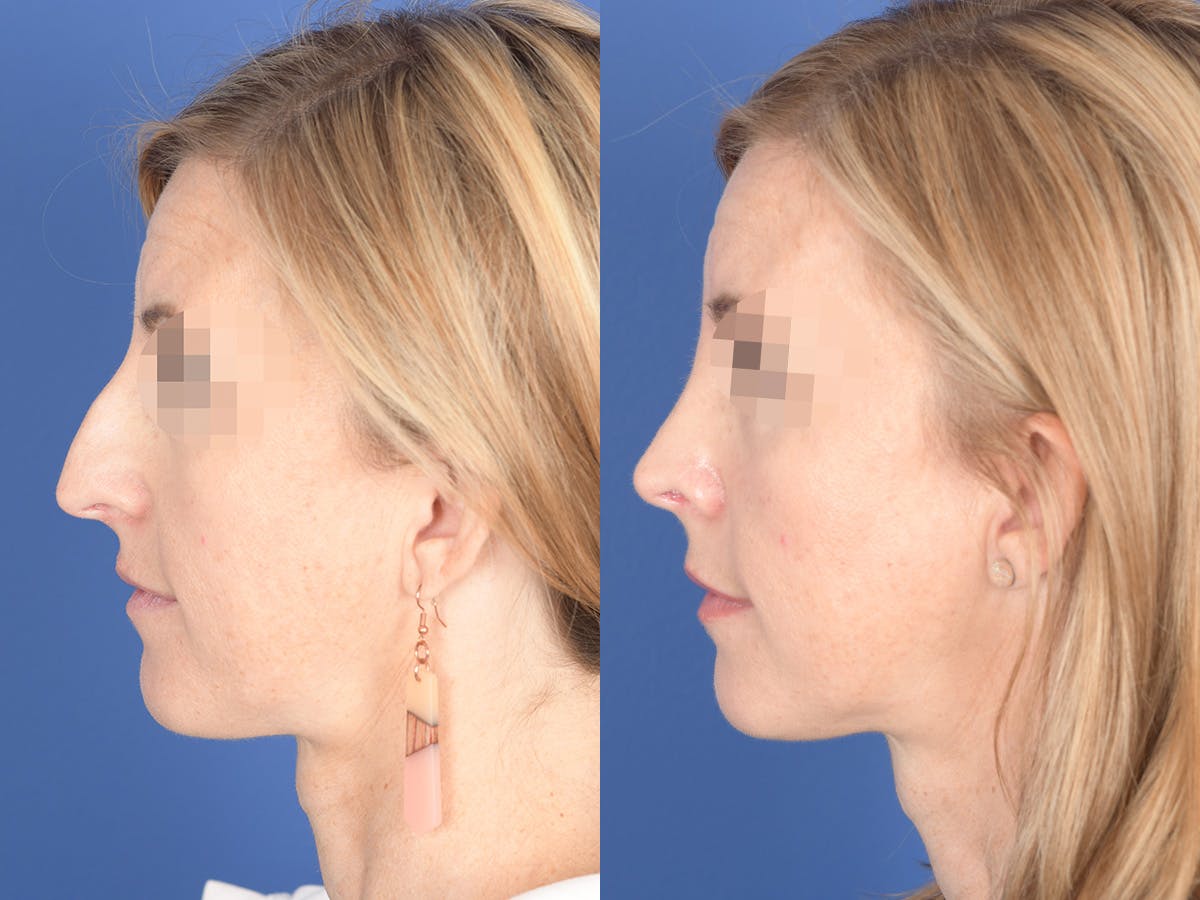 Rhinoplasty Before & After Gallery - Patient 378354 - Image 2