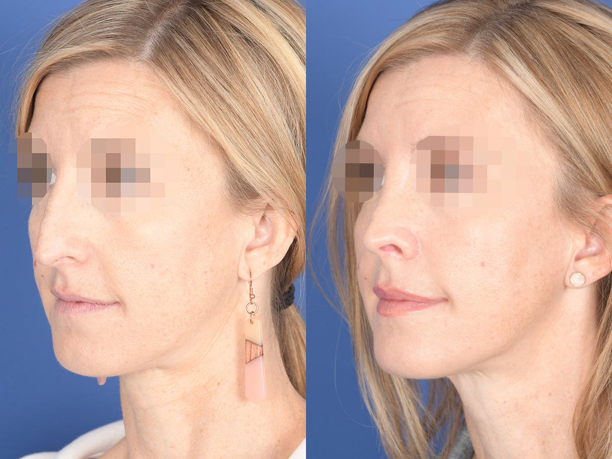 Rhinoplasty Before & After Gallery - Patient 378354 - Image 3