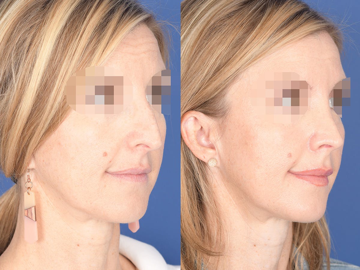 Rhinoplasty Before & After Gallery - Patient 378354 - Image 4