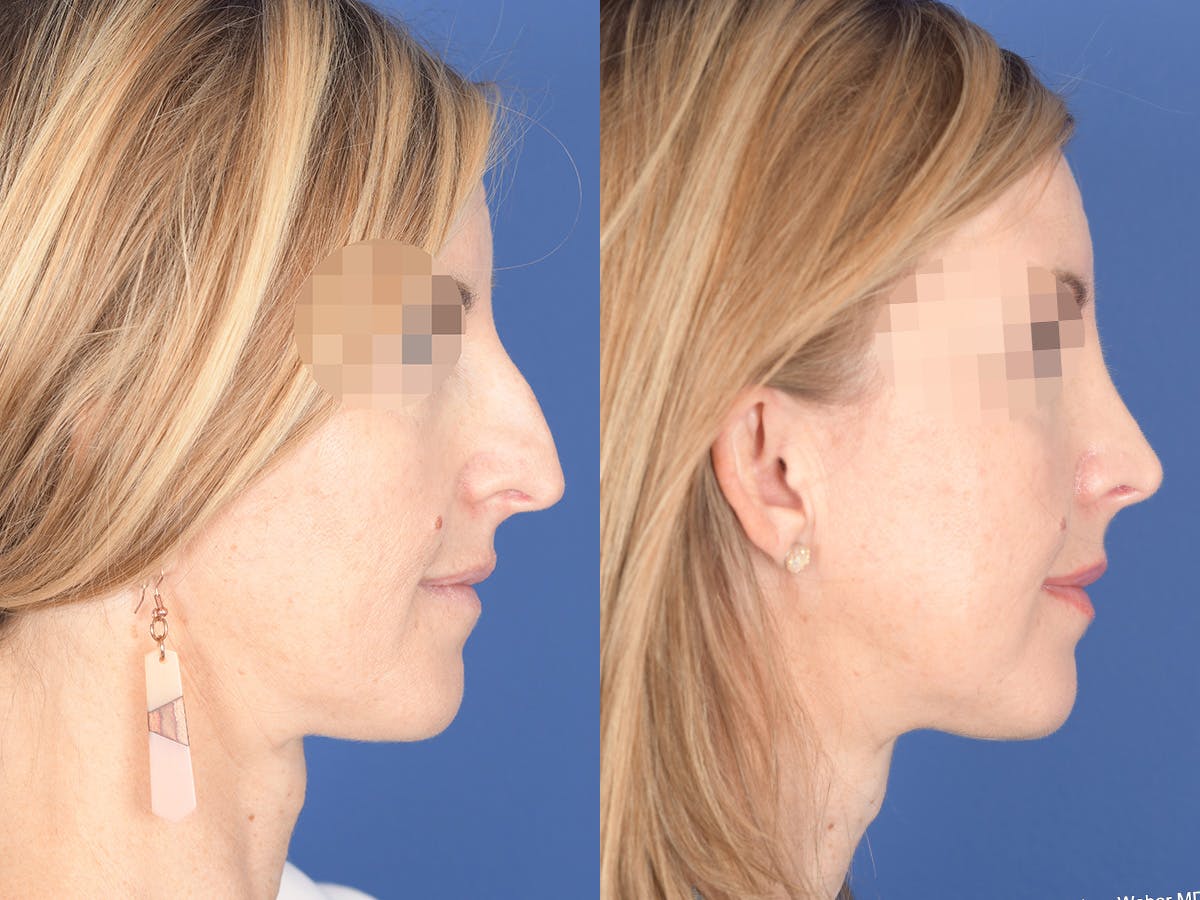 Rhinoplasty Before & After Gallery - Patient 378354 - Image 5