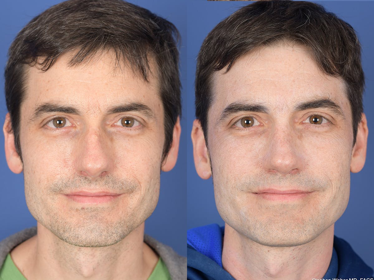 Rhinoplasty Before & After Gallery - Patient 282174 - Image 1